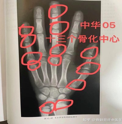 董路态度转变，一开始支持测骨龄，现在否认骨龄科学性